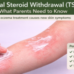 Topical Steroid Withdrawal (TSW): What Parents Need to Know. A Mom putting medicine cream on child arm.